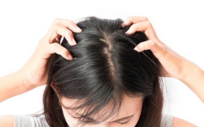 Cải thiện vảy nến da đầu cùng bộ đôi sản phẩm thảo dược