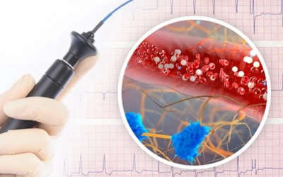 Tổng quan về phương pháp đốt điện tim điều trị rung nhĩ 