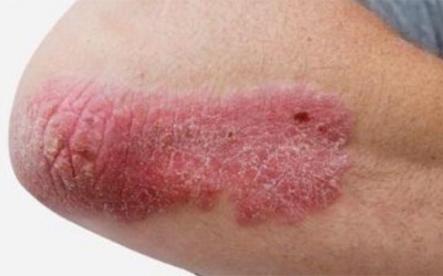 Giải pháp thảo dược cải thiện bệnh vảy nến thể mảng an toàn, hiệu quả