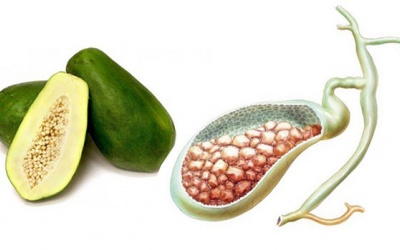 Chuyên gia giải đáp: Trị sỏi mật bằng đu đủ xanh có tốt không?