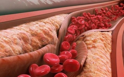 Những dấu hiệu nhận biết xơ vữa động mạch 