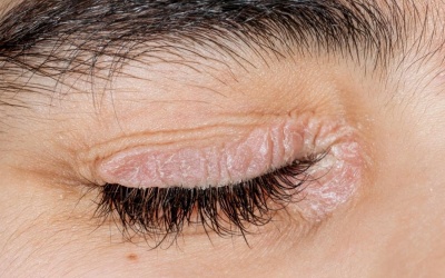 Cách ngăn ngừa biến chứng ở vảy nến vùng mắt