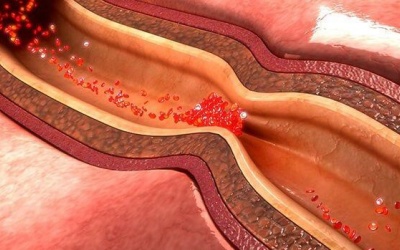 Co thắt mạch vành là gì: Những thông tin quan trọng bạn cần biết!