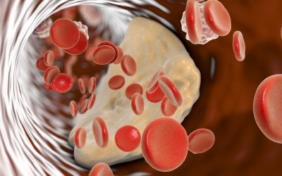 Những loại thuốc thường được chỉ định điều trị xơ vữa động mạch