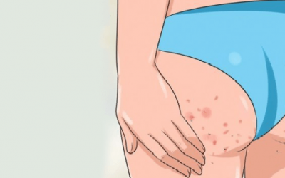 Bị mọc mụn ở mông, làm gì nhanh khỏi?