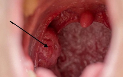 Nhận biết sớm căn bệnh ung thư cướp đi sinh mạng của nghệ sỹ Giang còi