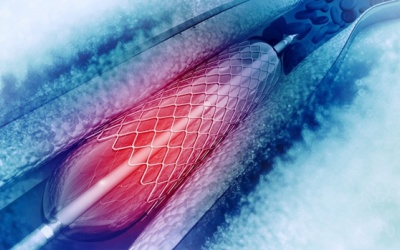Cần lưu ý gì để hồi phục sức khỏe sau phẫu thuật nong mạch, đặt stent?