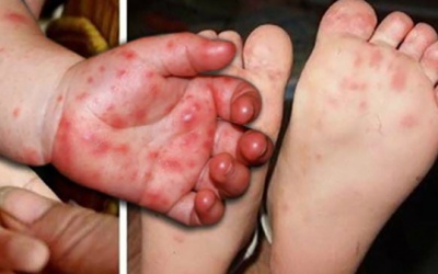 Bệnh tay chân miệng ở trẻ: Khi nào cần nhập viện?