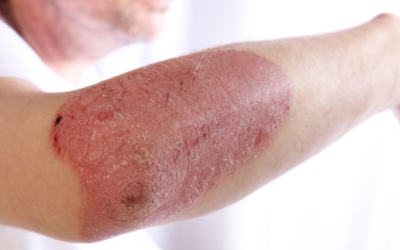 Những yếu tố nào khiến vảy nến thể mảng tái phát?