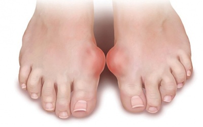 Hiểu đúng về bệnh gout và cách cải thiện bằng thảo dược