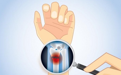 Biện pháp chủ động ngăn ngừa ung thư di căn xương