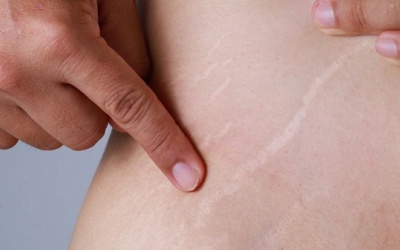 Mẹo khắc phục tình trạng rạn da bằng các nguyên liệu tự nhiên 