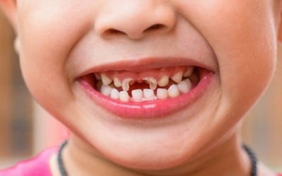 'Điểm mặt' những loại thực phẩm gây hại men răng của trẻ