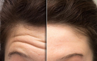 Bí kíp làm mờ và ngăn ngừa nếp nhăn trên trán