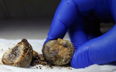 5 điều cần biết về sỏi đường mật: Triệu chứng, cách điều trị thế nào?