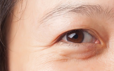 Mẹo “đánh bay” bọng mắt ngay tại nhà