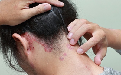 Bí quyết chăm sóc tóc dành cho người bệnh vảy nến da đầu