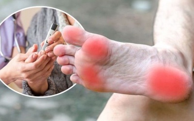 Tiền đái tháo đường nhưng đã gặp biến chứng tê bì, kiến cắn tay chân