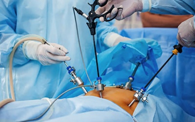 Khi nào nên mổ u nang buồng trứng?