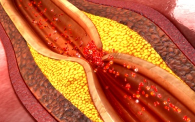 Mỡ máu cao nguy cơ gây xơ vữa động mạch