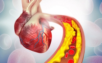 Làm thế nào để phòng ngừa xơ vữa động mạch đi kèm mỡ máu cao?
