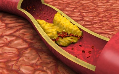 Người mỡ máu cao nên và không nên ăn gì để phòng ngừa xơ vữa động mạch