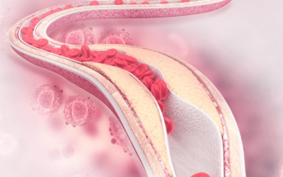 Cách phòng xơ vữa động mạch ở người mỡ máu cao