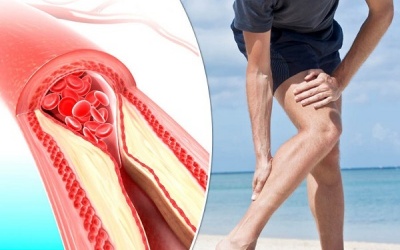 Xơ vữa động mạch kèm mỡ máu cao làm tăng nguy cơ tàn phế?