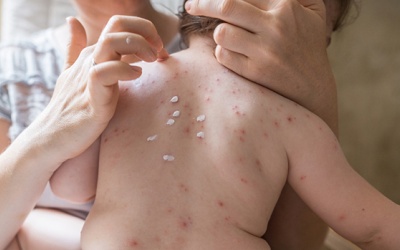 Trẻ bị thủy đậu kiêng gì để nhanh khỏi bệnh?