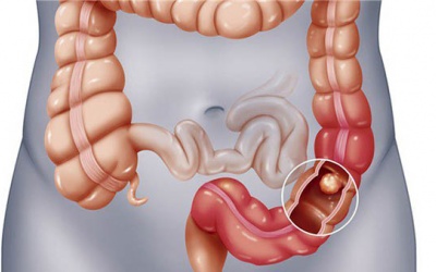 Dấu hiệu nhận biết sớm bệnh ung thư trực tràng