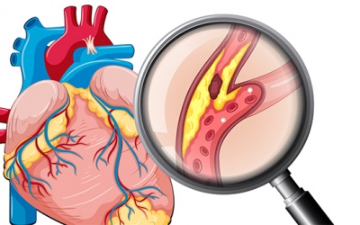 Các biện pháp để xác định bệnh xơ vữa động mạch vành hiện nay