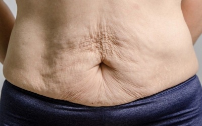 Làm sao để khắc phục tình trạng da chùng nhão, chảy xệ sau giảm cân?