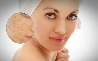 Cách làm mờ sẹo mụn bằng cách tự nhiên dễ dàng thực hiện ngay tại nhà
