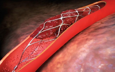 Ưu và nhược điểm của phương pháp đặt stent động mạch vành