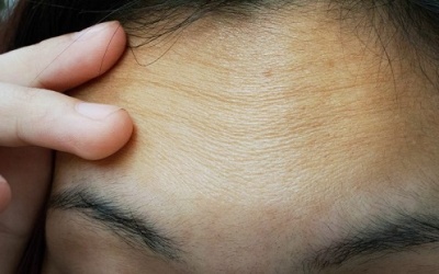 5 thói quen giúp xóa nếp nhăn trên trán ngay tại nhà