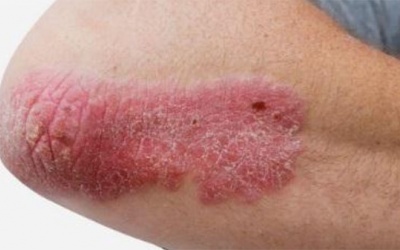 Cách cải thiện bệnh vảy nến thể mảng bằng sản phẩm thảo dược