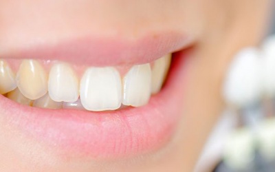 Răng bị ố vàng phải làm sao?