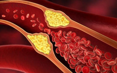 Làm thế nào để dự phòng bệnh xơ vữa động mạch?