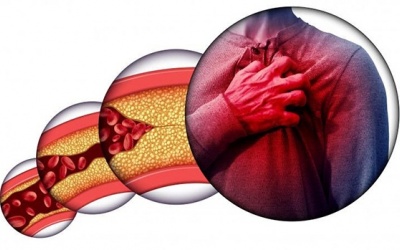 Vì sao người gầy vẫn bị máu nhiễm mỡ?