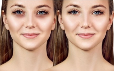 Cải thiện đôi mắt “gấu trúc” bằng những thực phẩm tự nhiên