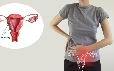 3 biến chứng thường gặp sau phẫu thuật u xơ tử cung