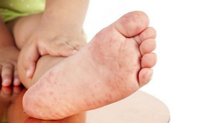 Dấu hiệu nhận biết sớm bệnh tay chân miệng độ 1 cha mẹ cần lưu ý