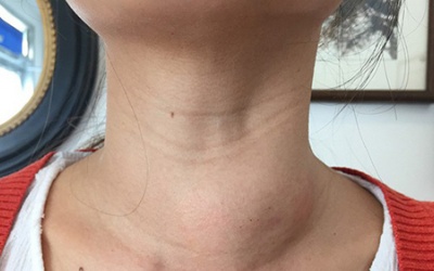 Bướu keo tuyến giáp là gì? Làm sao để điều trị bệnh hiệu quả?