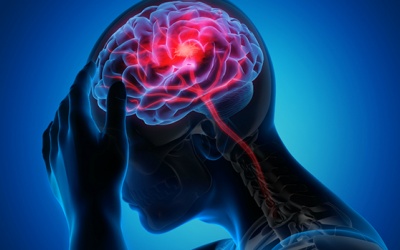  5 biến chứng thường gặp của nhồi máu não