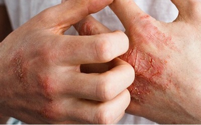 Những loại thuốc thường dùng trong điều trị viêm khớp vảy nến