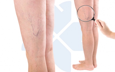 Làm thế nào để thoát khỏi chứng suy giãn tĩnh mạch một cách tự nhiên?