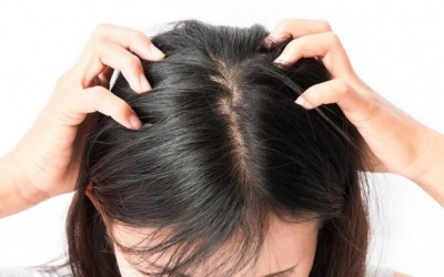 5 mẹo đơn giản và hiệu quả để ngăn ngừa gàu vào mùa Đông