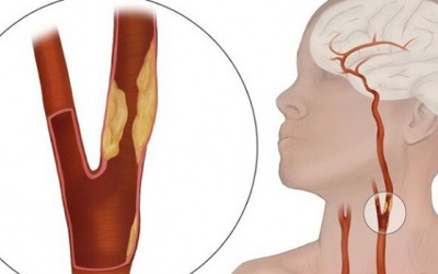 Xơ vữa động mạch cảnh: Nguyên nhân và dấu hiệu nhận biết thế nào?