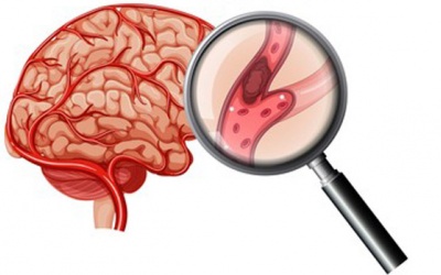 Chẩn đoán xơ vữa động mạch não như thế nào?