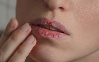 Mách bạn cách “đánh bay” môi khô, nứt nẻ trong mùa lạnh